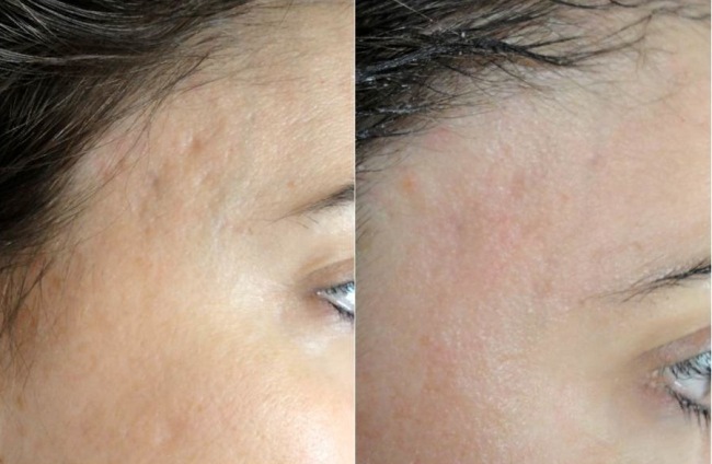 acne scar.011.jpg